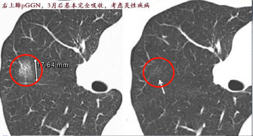 女子肺部磨玻璃结节癌变理赔遭拒，健康保险的挑战应对之道探讨