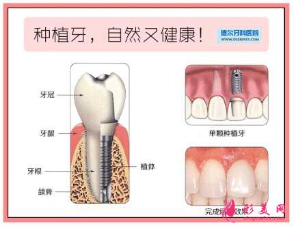 种植牙最长寿命，了解、实践与未来展望