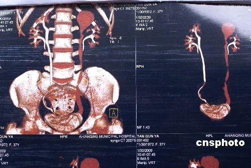 2个月女婴被查出有4个肾