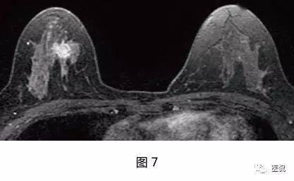 乳腺腺病，全面理解、诊断与治疗指南